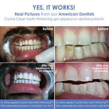 Load image into Gallery viewer, Crystal Clear Teeth Whitening At-Home Teeth Whitening All-in-One Kit