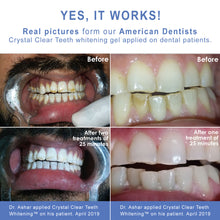 Load image into Gallery viewer, Crystal Clear Teeth Whitening US Dentists-Approved, Rechargeable Waterproof Teeth Whitening All-in-One Kit