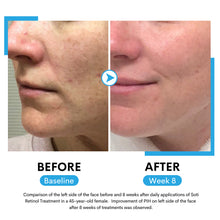 Load image into Gallery viewer, Soti 2.5% Retinol Serum, Formulated in USA! Reduces Wrinkles, Age Spots, Post-Acne Marks. Stimulates Collagen, Firm Skin, Anti Aging with Hyaluronic Acid, Niacinamide (30ml)