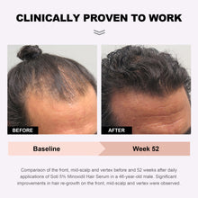 Load image into Gallery viewer, Soti Minoxidil 5% Hair Growth, Hair Loss Regrowth Serum.  Formulated in USA!  Dermatologists Recommended. Extra Strength Formula (3 Pack)