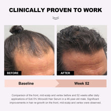 Load image into Gallery viewer, Soti Minoxidil 5% Hair Growth, Hair Loss Regrowth Serum.  Formulated in USA!  Dermatologists Recommended. Extra Strength Formula (6 Pack)