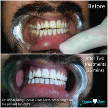 Load image into Gallery viewer, crystal clear teeth whitening results