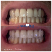 Load image into Gallery viewer, crystal clear teeth whitening results