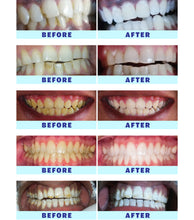 Load image into Gallery viewer, Crystal Clear Teeth Whitening US Dentists-Approved, Rechargeable Waterproof Teeth Whitening All-in-One Kit