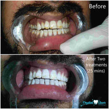 Load image into Gallery viewer, Crystal Clear Teeth Whitening US Dentists-Approved, Rechargeable Waterproof Teeth Whitening All-in-One Kit