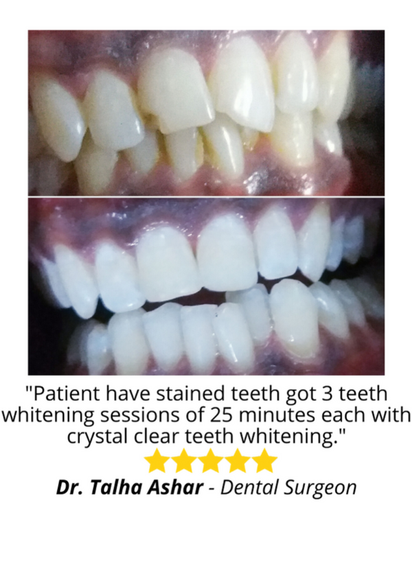 Real before and after results picture Crystal Clear Teeth Whitening 