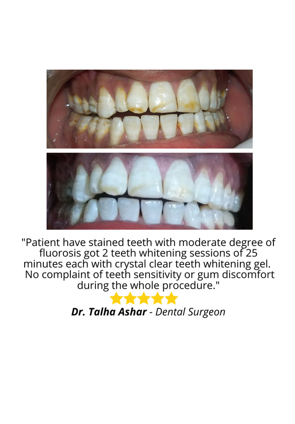 Real before and after results picture Crystal Clear Teeth Whitening 