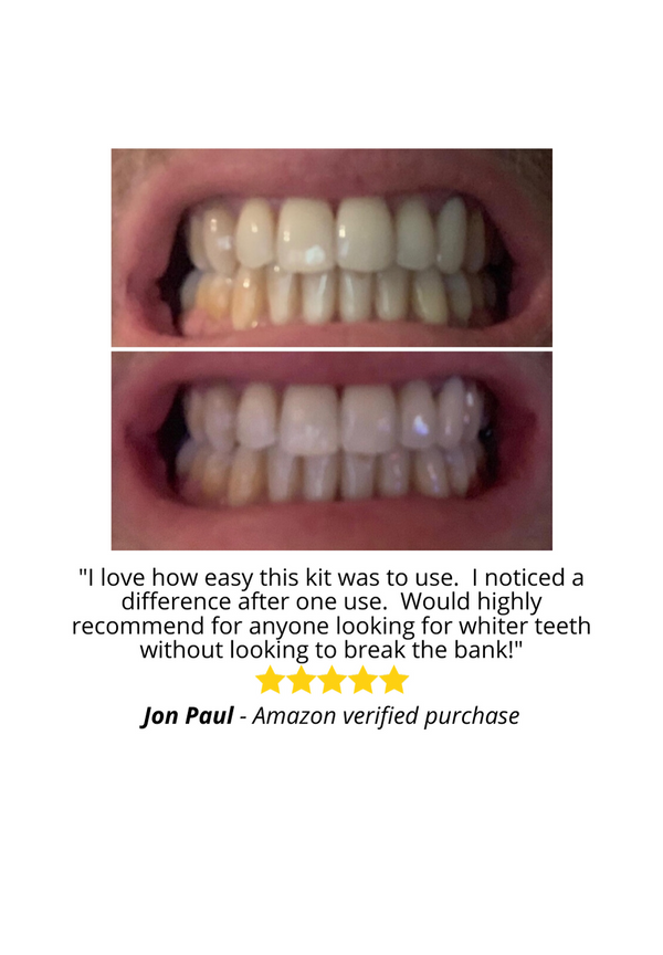 Real before and after results picture Crystal Clear Teeth Whitening 