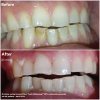 Crystal Clear Teeth Whitening Kit whitening results