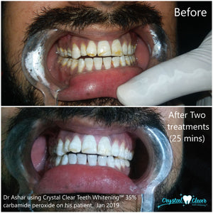 Crystal Clear Teeth Whitening Gel Refill - 3 Pack