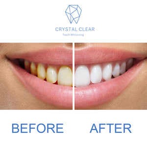 Crystal Clear Teeth Whitening Gel Refill - 10 Pack