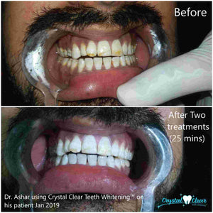 crystal clear teeth whitening results